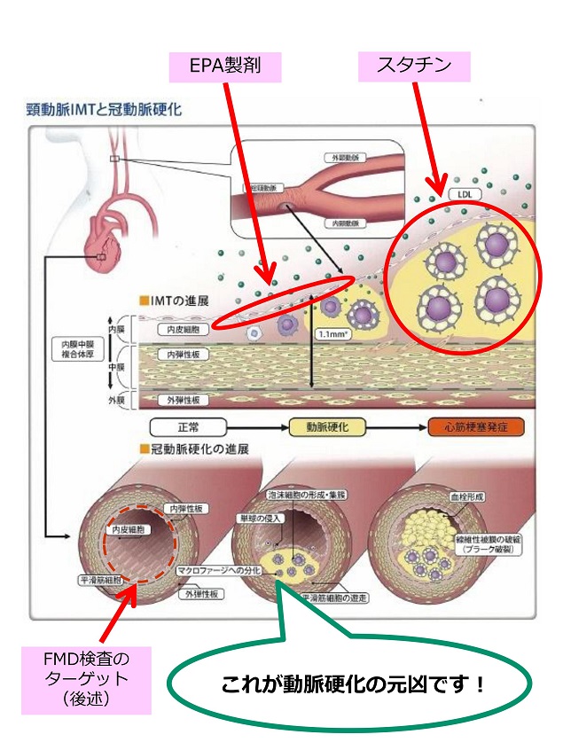 arteriosclerosis44.jpg